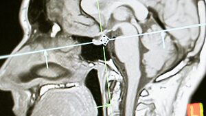 When substance use disorder takes hold, it physically changes the brain